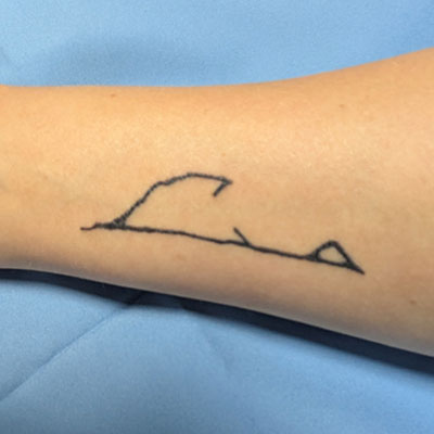 A tattoo of a ancient fish hook on an arm